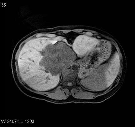 Submassive Hepatic Necrosis Image