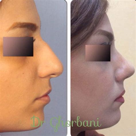 Persian Nose Jobs Before And After Photos 6 Rhinoplasty Cost Pics