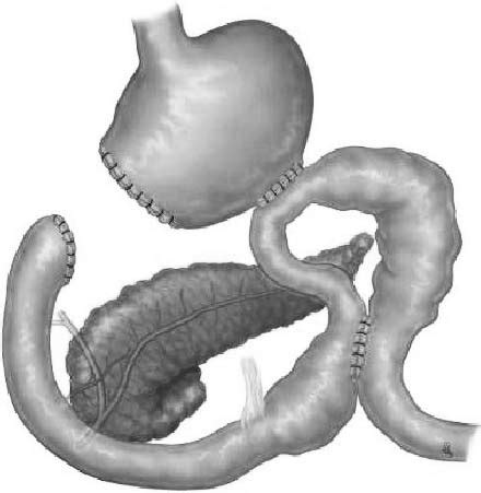 Partial Gastrectomy