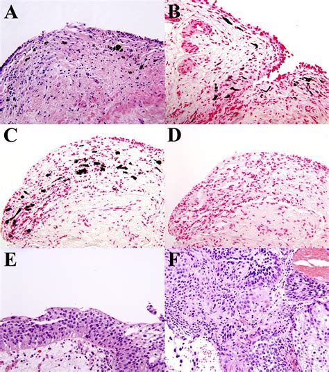 References In High Grade Transitional Cell Carcinoma And Melanosis Of