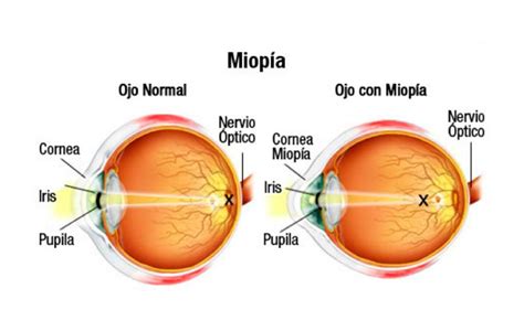 Anomal As De La Visi N Parte I La Miop A Alva Pticos
