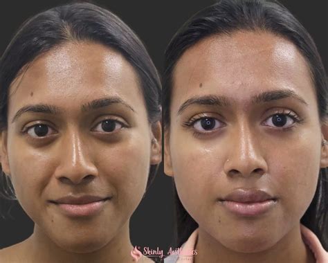 Smile Line Fillers Before After Results At Skinly