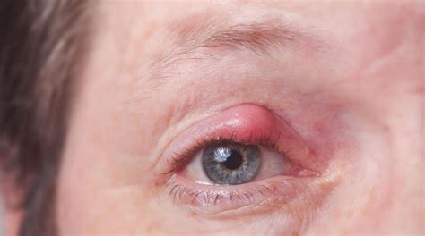 How To Treat A Stye In The Eye Under Eyelid Avoid