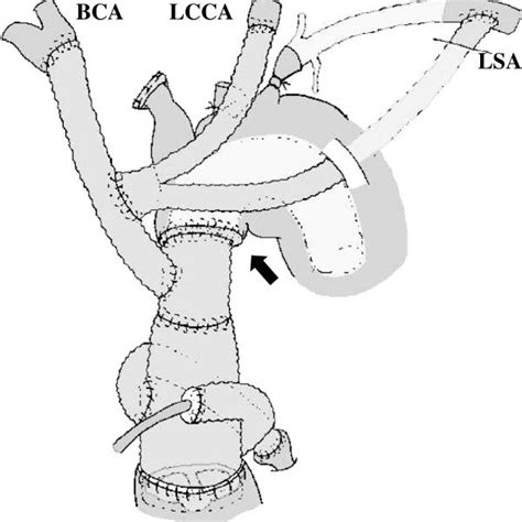 Schematic of the first operation. Distal anastomosis is accomplished ...