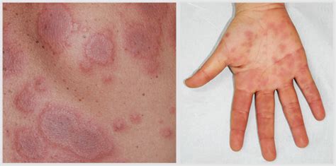 Erythema Multiforme Huidinfonl