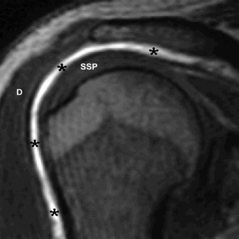 Pdf Injection Of The Subacromial Subdeltoid Bursa Blind Or Ultrasound Guided