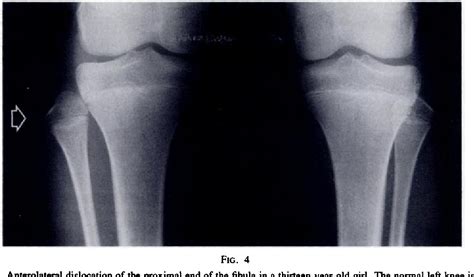 Figure 2 from Subluxation and dislocation of the proximal tibiofibular ...