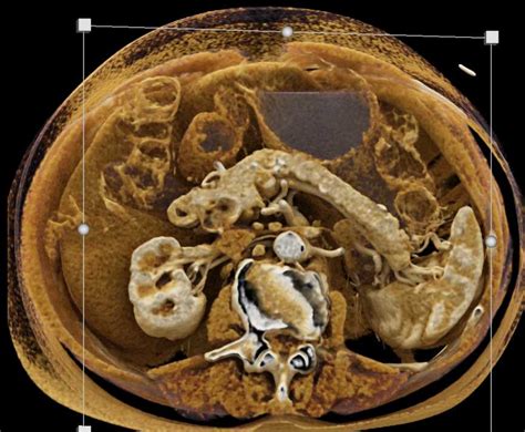 Incidental Pancreatic Neuroendocrine Tumor Pnet In Body Of The