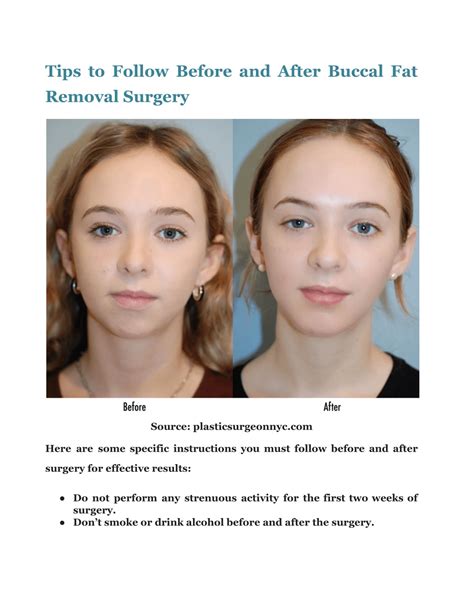 Ppt Buccal Fat Removal Before And After Scenarios A Quick Guide