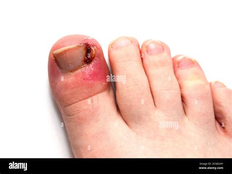 Infected Ingrown Toenail Abscess