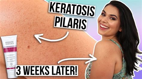 Keratosis Pilaris Arms How To Get Rid