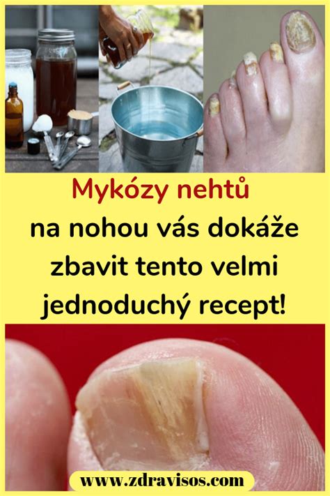 Myk Zy Neht Na Nohou V S Dok E Zbavit Tento Velmi Jednoduch Recept