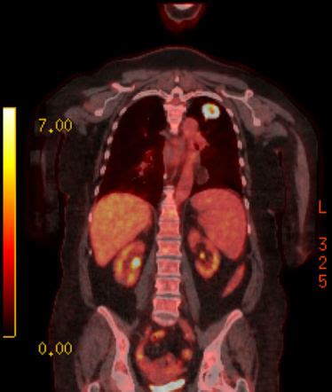 Positron Emission Tomography Radiology Reference Article