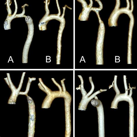 3d Reconstruction Of Aorta In Four Different Patients Before A And Download Scientific