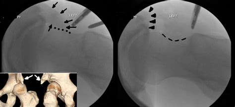 Left Intraoperative Fluoroscopic Views Of A Patient Case With A