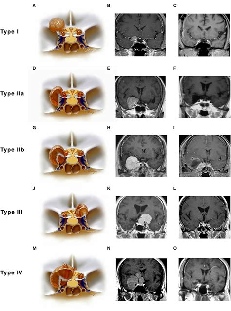 Frontiers Anterior Clinoidal Meningiomas Meningeal Anatomical