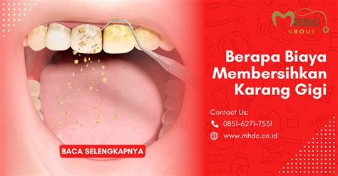 Biaya Membersihkan Karang Gigi Terbaru Manfaatnya