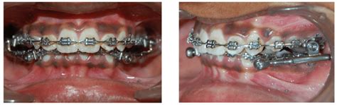 Powerscope Tm Class Ii Corrector Frontal And Left Lateral View Download Scientific Diagram