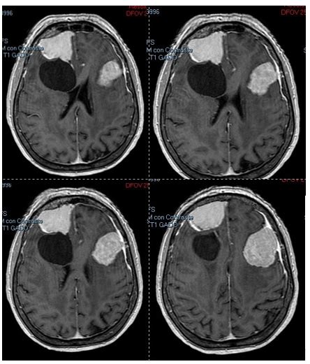 How Much Does Age Matter Aggressive Management Of Frontal Mirror