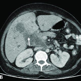 PDF Imaging In Obstructive Jaundice What A Radiologist Needs To Know