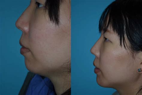 Genioplasty Before & After Gallery