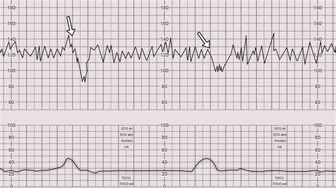 How To Read A Ctg Ctg Interpretation Geeky Medics