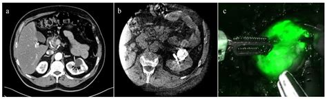 Near Infrared Fluorescent Guided Robot Assisted Renal Surgery