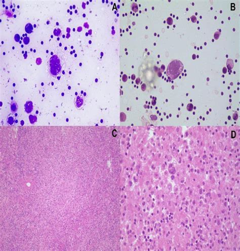 Post Centrifugation Smears From Pleural Fluid Showing Atypical Lymphoid Download Scientific