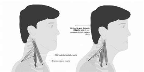 Forward Head Posture Muscles Involved