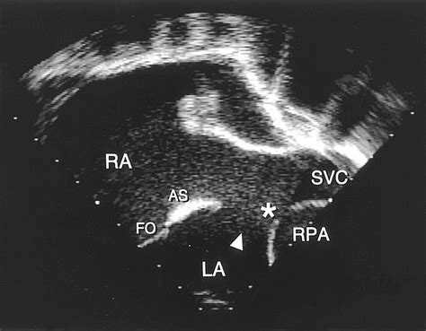 Diagnosis Of Sinus Venosus Atrial Septal Defect With Transesophageal