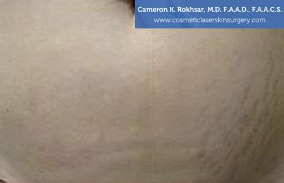 Stretch Mark Removal Before And After Photos Dr Cameron Rokhsar