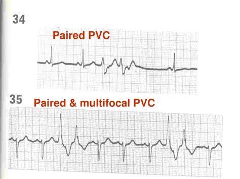 Ppt Ecg Interpretation Powerpoint Presentation Free Download Id