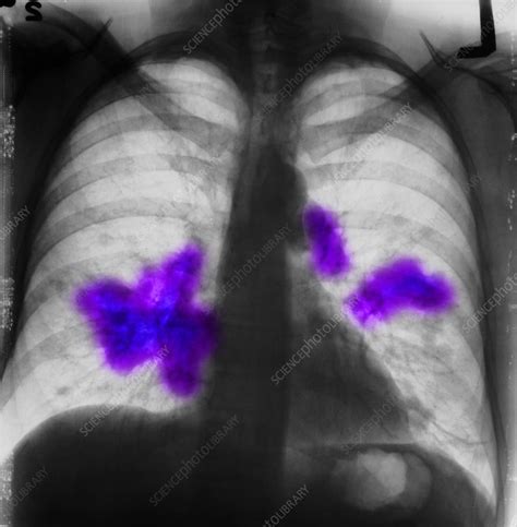 Lung Cancer Chest X Ray Stock Image C039 4327 Science Photo Library