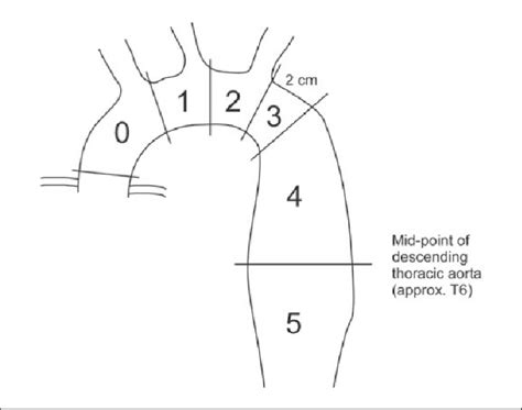 Location Of Proximal Landing Zones See Text For Details Adapted