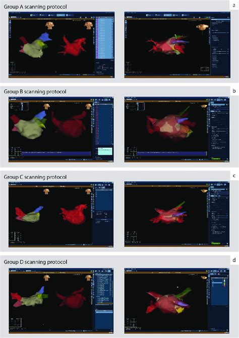 Parallel Views Of D Electroanatomical Maps With Ct Generated La