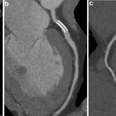 51-year-old patient with complete in-stent occlusion of left circumflex ...