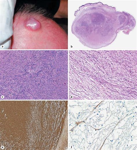 Cutaneous Schwannoma