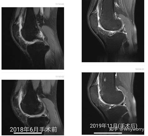 我的膝关节软骨伤治疗之路 有图有真相 知乎