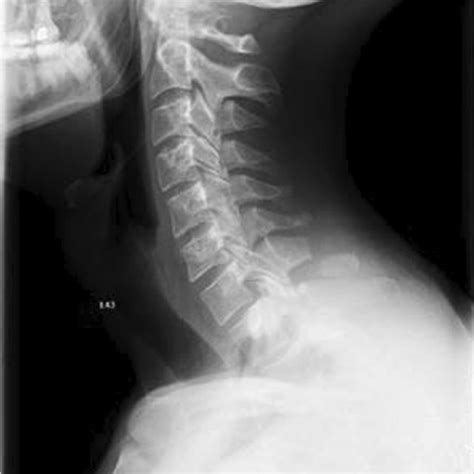 Lateral Neck X Ray Taken At Admission X Ray Computed Tomography And Download Scientific