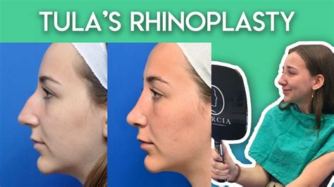 Tula S Rhinoplasty Journey YouTube