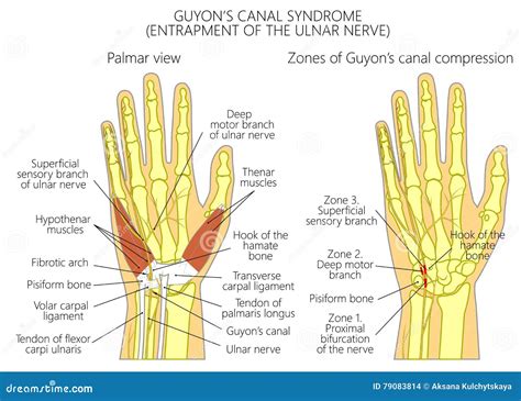 Entrapment Of The Ulnar Nerve In The Wrist In The Guyon S Canal