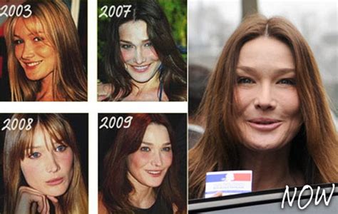 Les confidences de Carla Bruni sur sa chirurgie esthétique