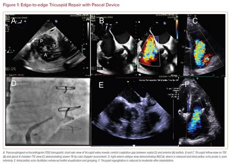 Edge To Edge Tricuspid Repair With Pascal Device Radcliffe Cardiology