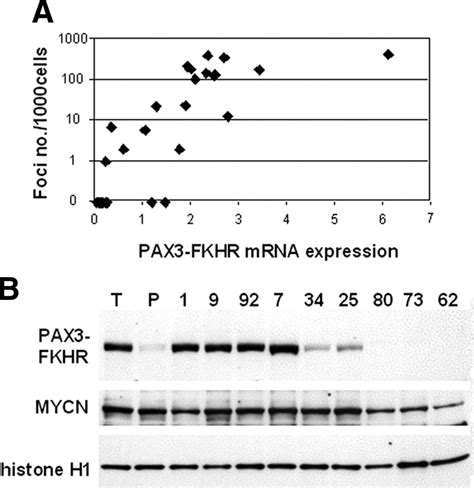 High Expression Of The PAX3 FKHR Oncoprotein Is Required To Promote