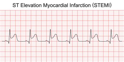 Acute Myocardial Infarction On ECG ECG Disease Patterns