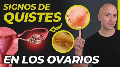 SI TIENES UNO DE ESTOS SÍNTOMAS PUEDES TENER QUISTES EN LOS OVARIOS