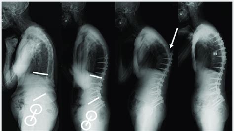 Lateral Whole Spine Standing Radiographs A Pre Operative Radiograph Download Scientific