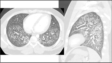 CT Image Demonstrates Bilateral Patchy Ground Glass Opacities And