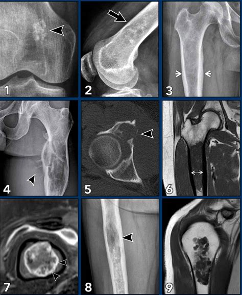 The Radiology Assistant Cartilage Tumors