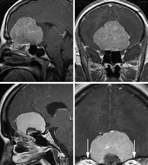 Olfactory Groove Meningioma The Neurosurgical Atlas